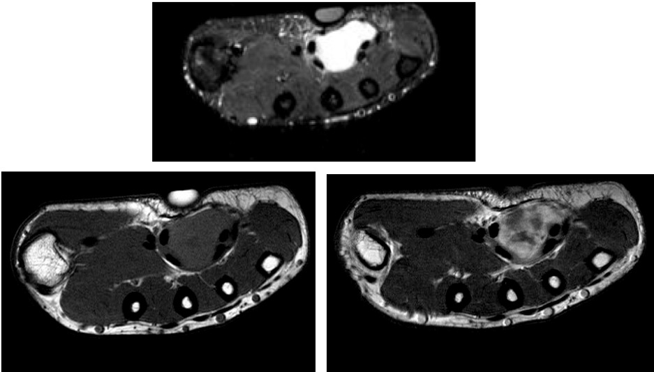 Figure 3 for case Nodular Faciitis